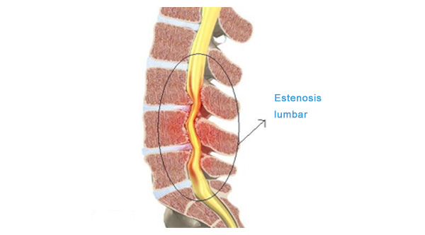Estenosis Lumbar