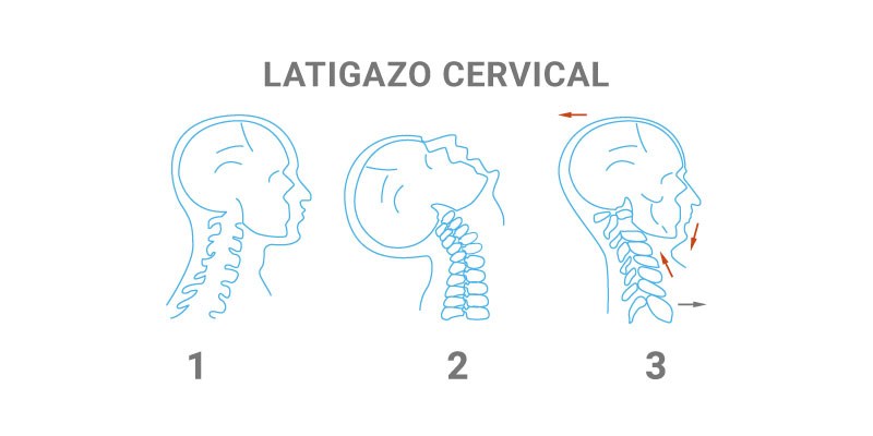 Latigazo Cervical II - Fisioterapia Goya