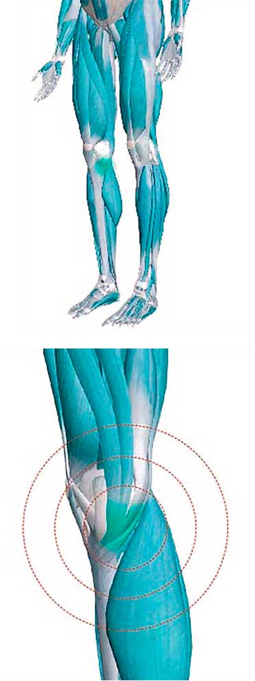 tendinitis de la pata de gansos