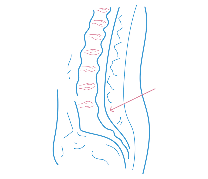 Tratamiento hernia discal