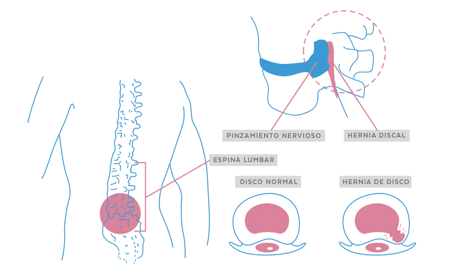 Tratamiento hernia discal