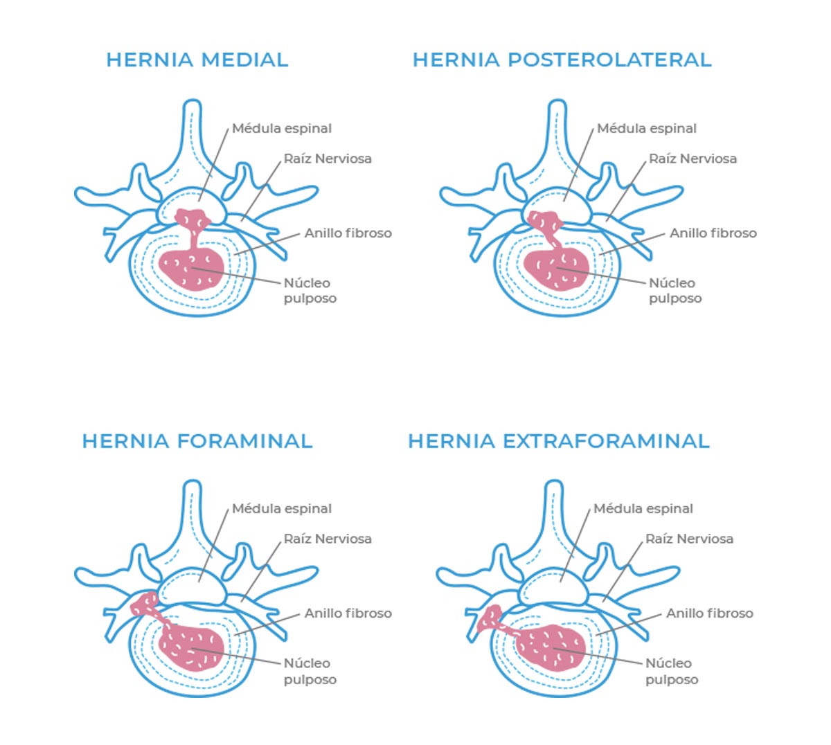 Tipos de hernias discales