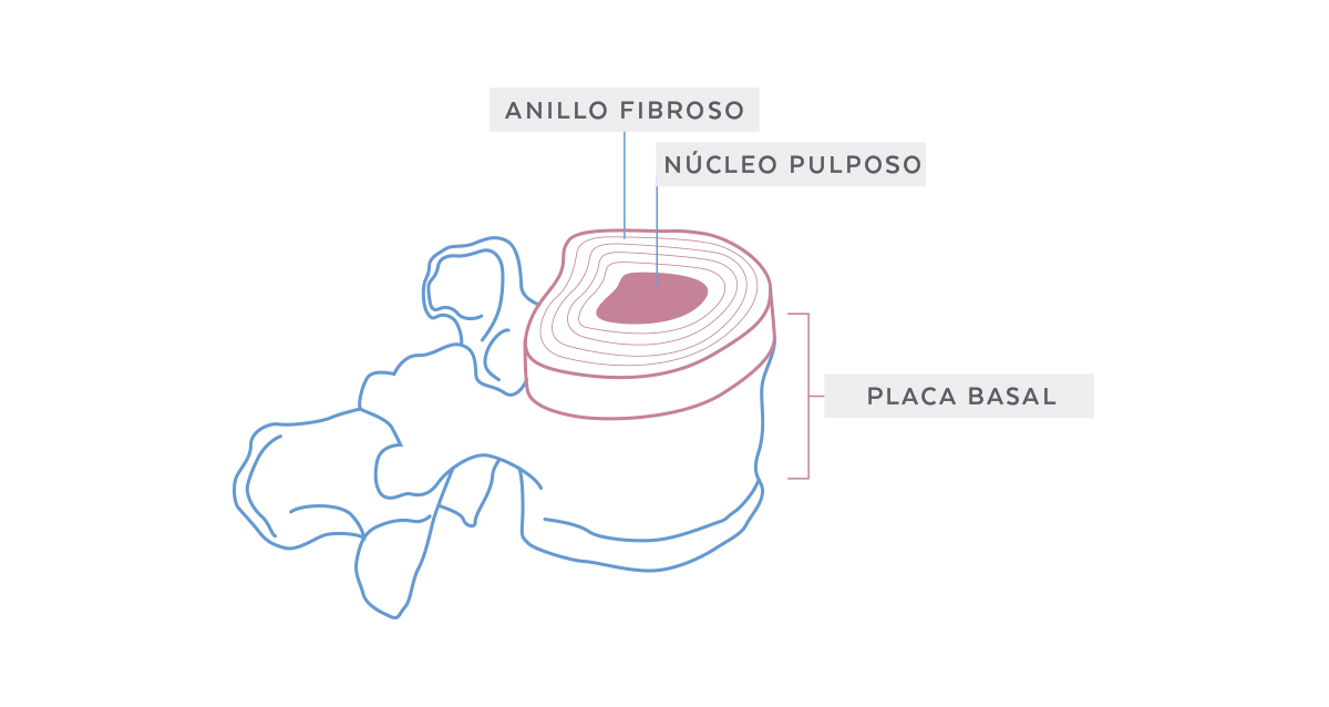 Protusión Discal - Anillo, Núcleo y Placa