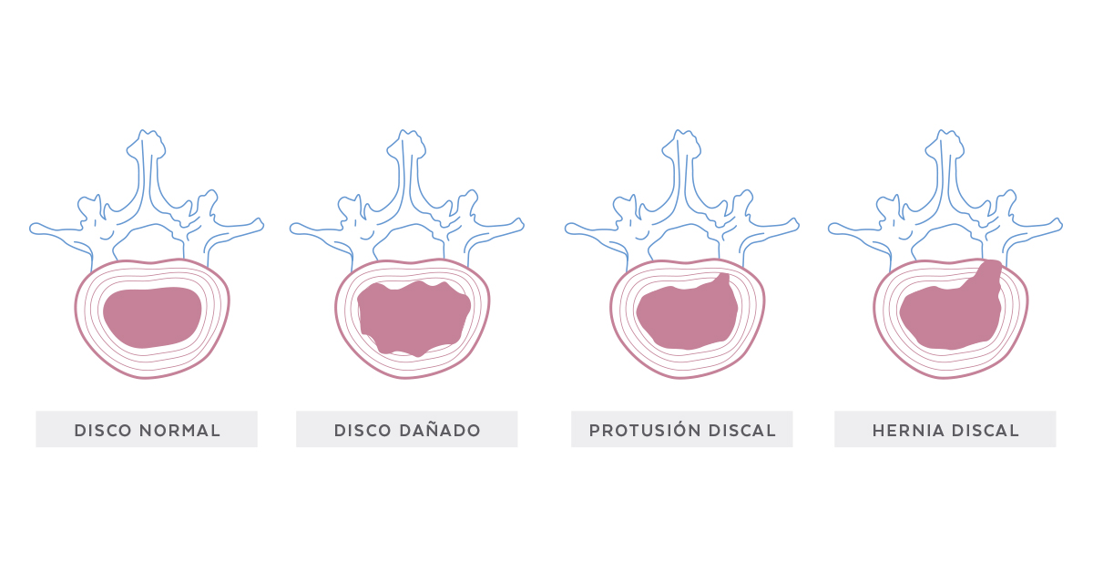 Tipos Protusiones Discales - Fisioterapia Goya