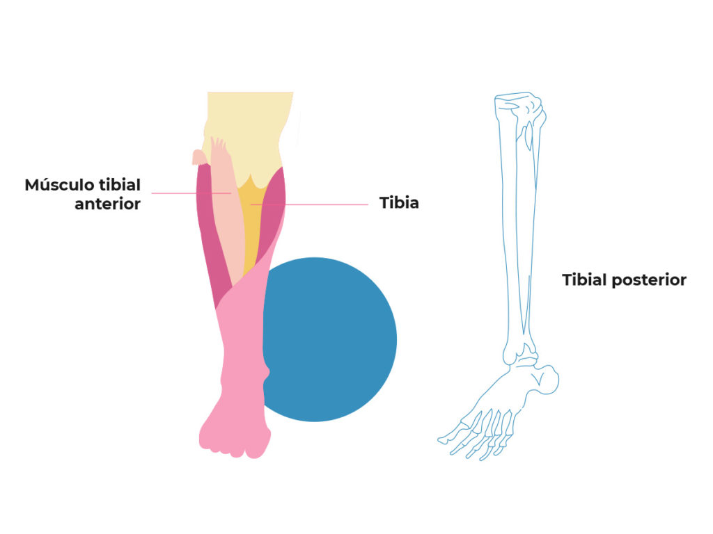 Periostitis tibial - Anterior y Posterior