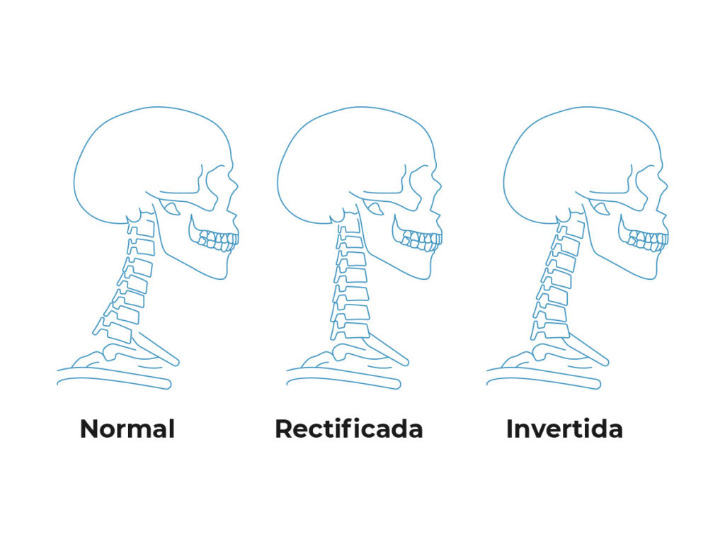 Rectificación Cervical - Tipos