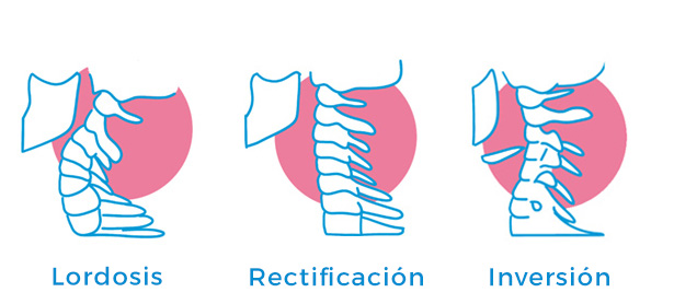 Lordosis Cervical - Tipos, Síntomas y Tratamiento