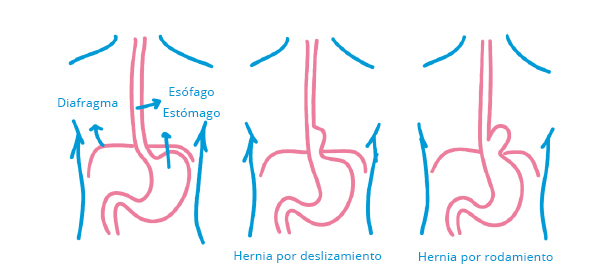 Tipos de Hernia de Hiato - Fisioterapia Madrid