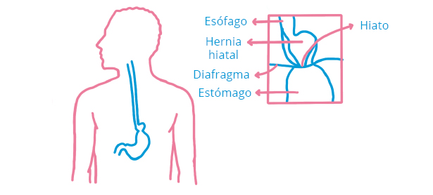 Diafragma - Hernia de Hiato