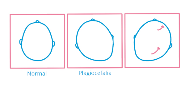 Factores plagiocefalia