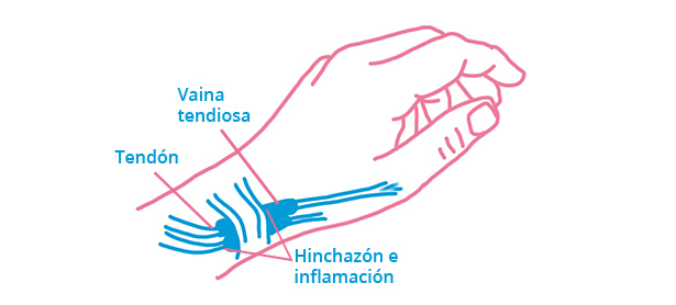Tendinitis de Quervain o tenosinovitis - Fisioterapia