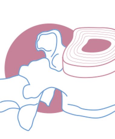 fisio-goya-protusión-discal