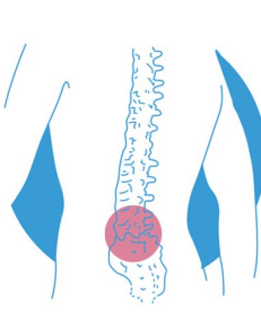 hernia-discal-madrid