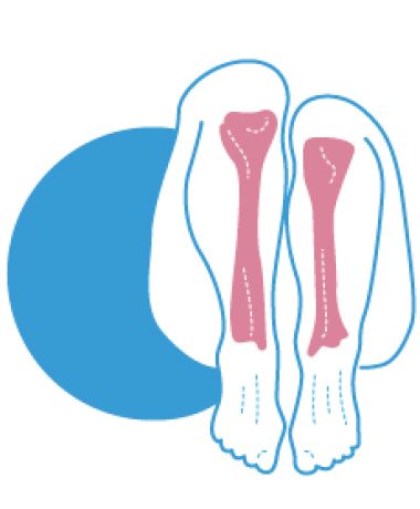 portada-falsa-pierna-corta-dismetria-pierna-corta-anatomica-fisioterapia-goya
